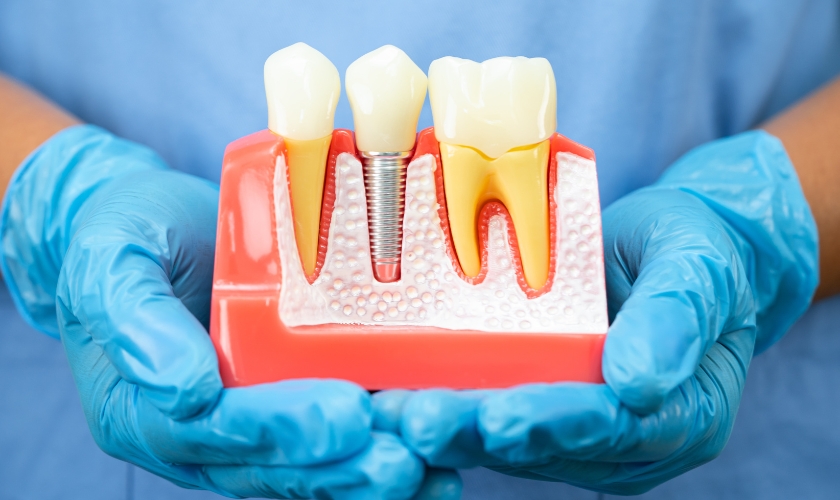 dental implants in Plantation