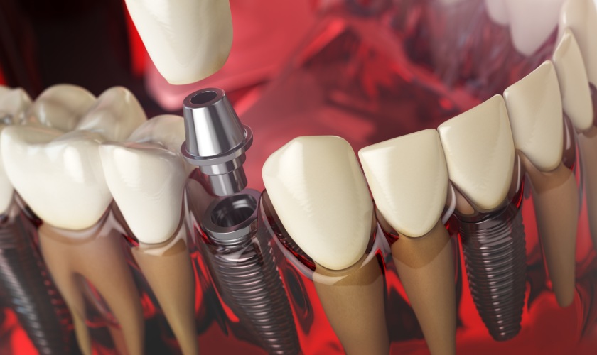 implants
